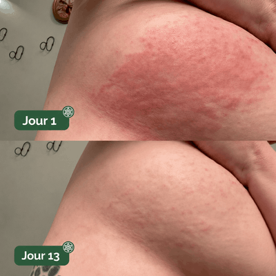 DermaPlis — Soin Barrière Expert Intertrigo
