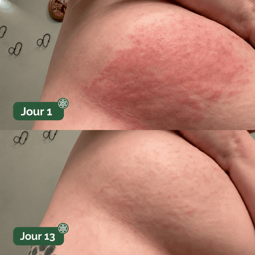 DermaPlis — Soin Barrière Expert Intertrigo