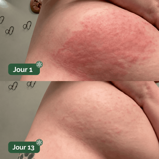 DermaPlis — Soin Barrière Expert Intertrigo
